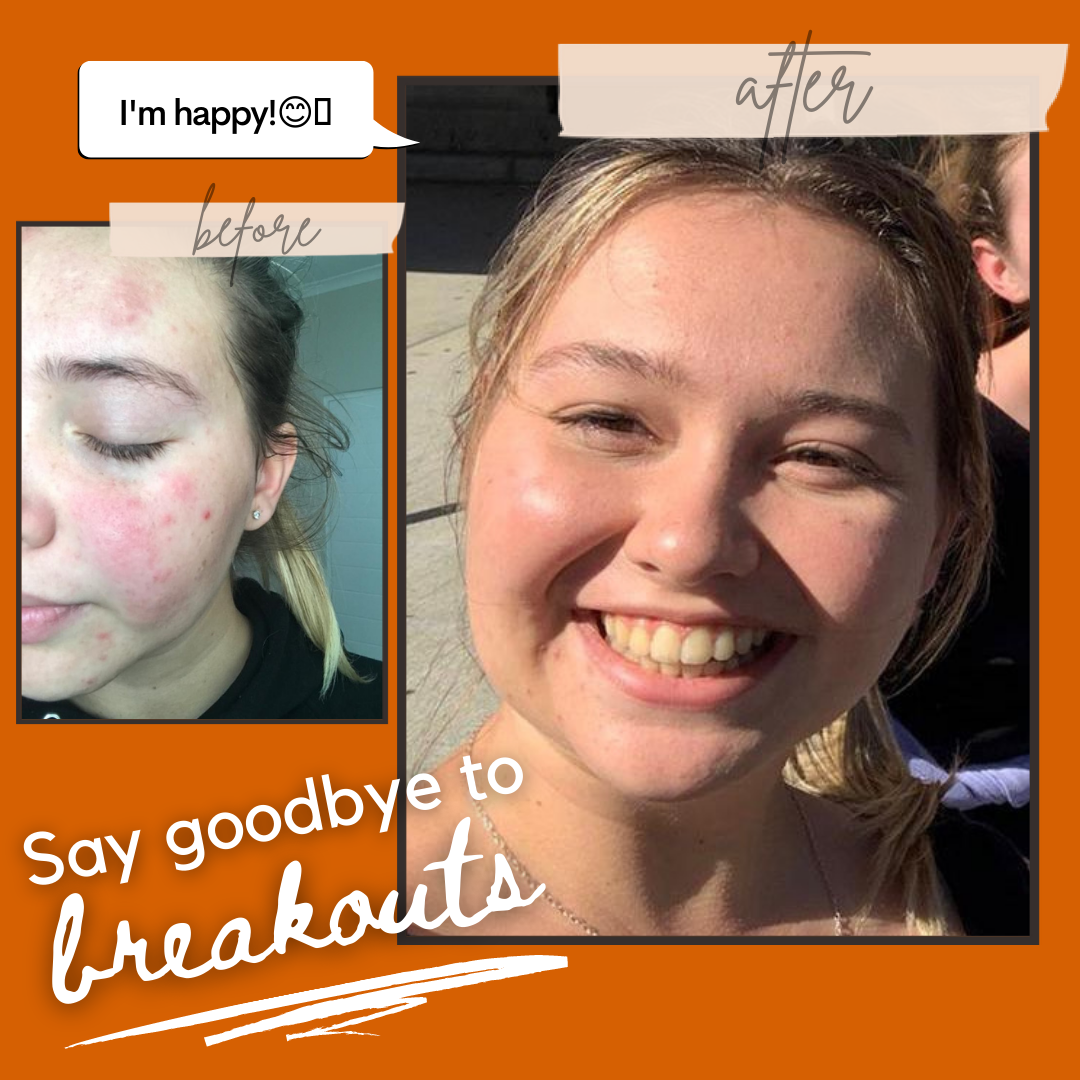 Teen Skincare Set